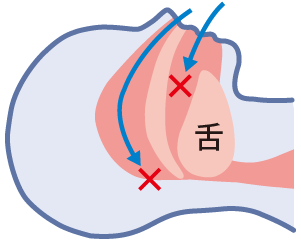 睡眠時無呼吸症候群（閉塞型）